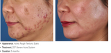 Acné Control 60 ml  - Zo Skin Health